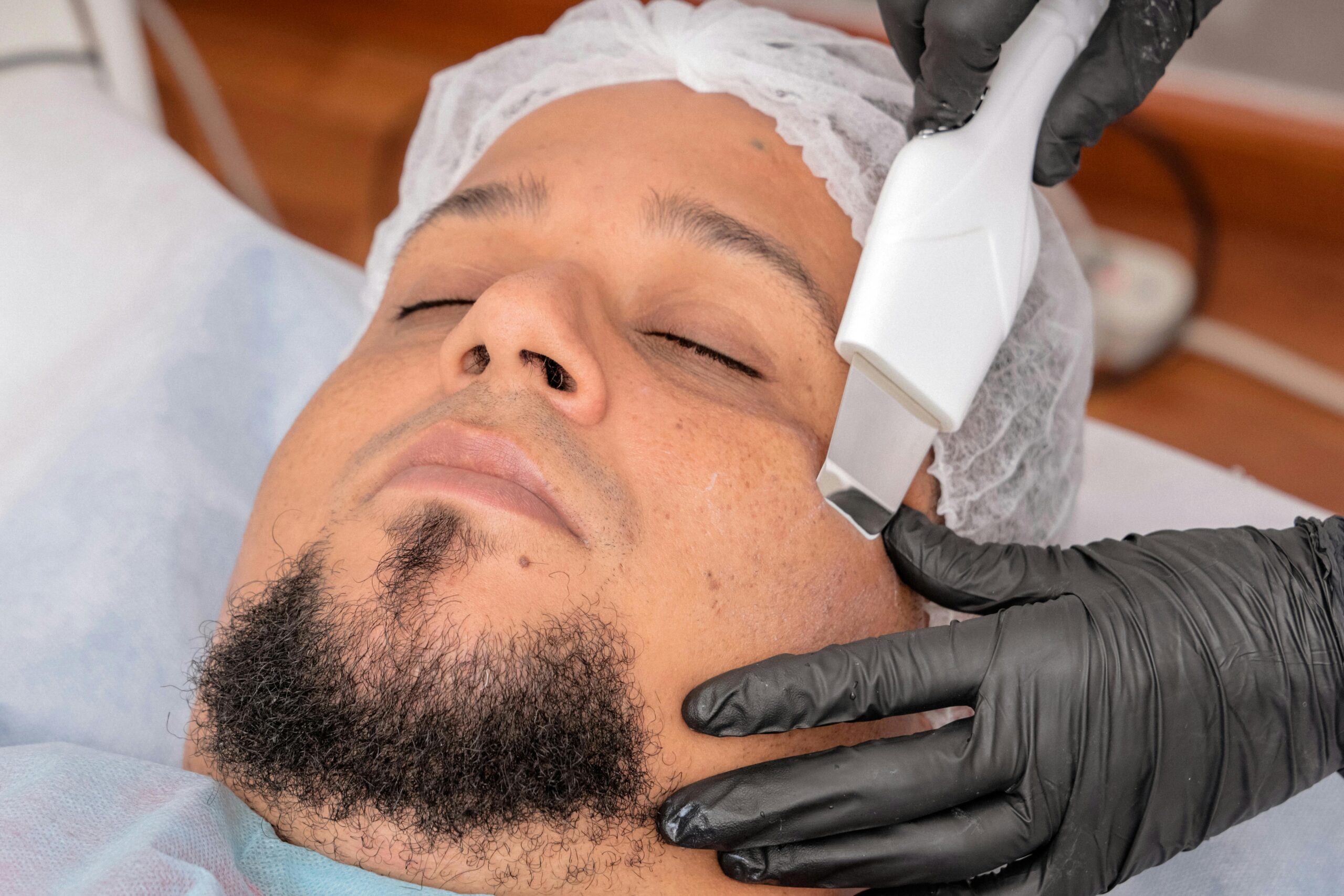Chemical Peels Treatment