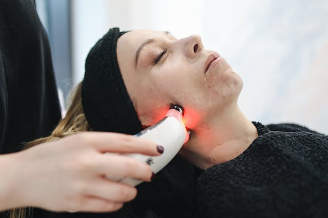 Q-Switch Laser Treatment