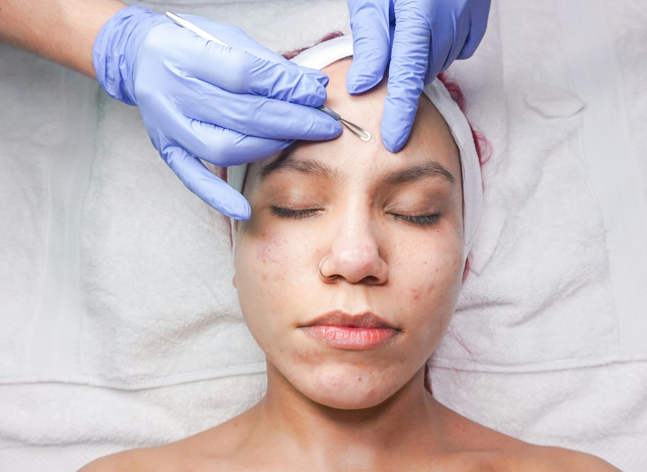 Active Acne Treatment