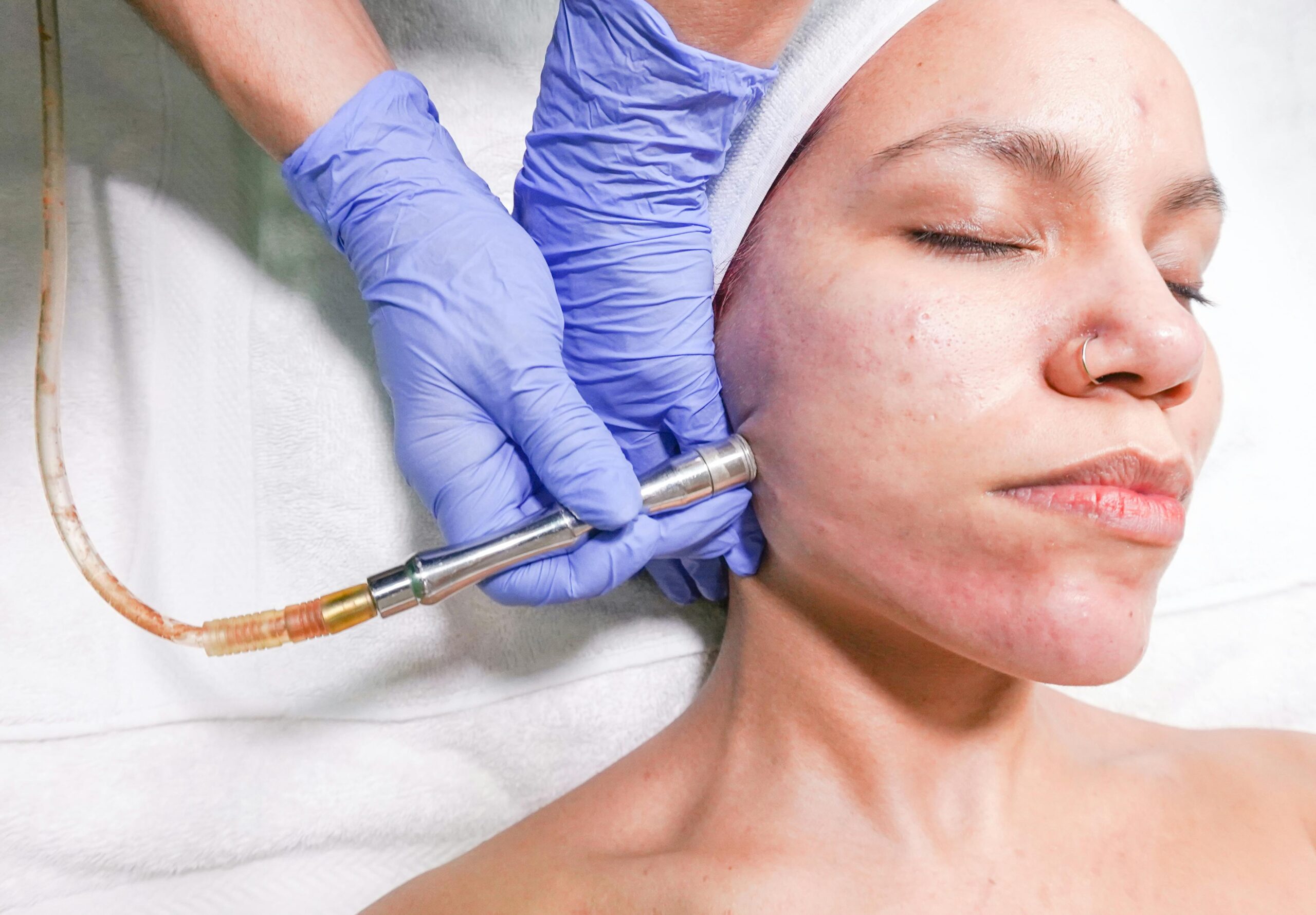 Acne Scar Treatment Microneedling