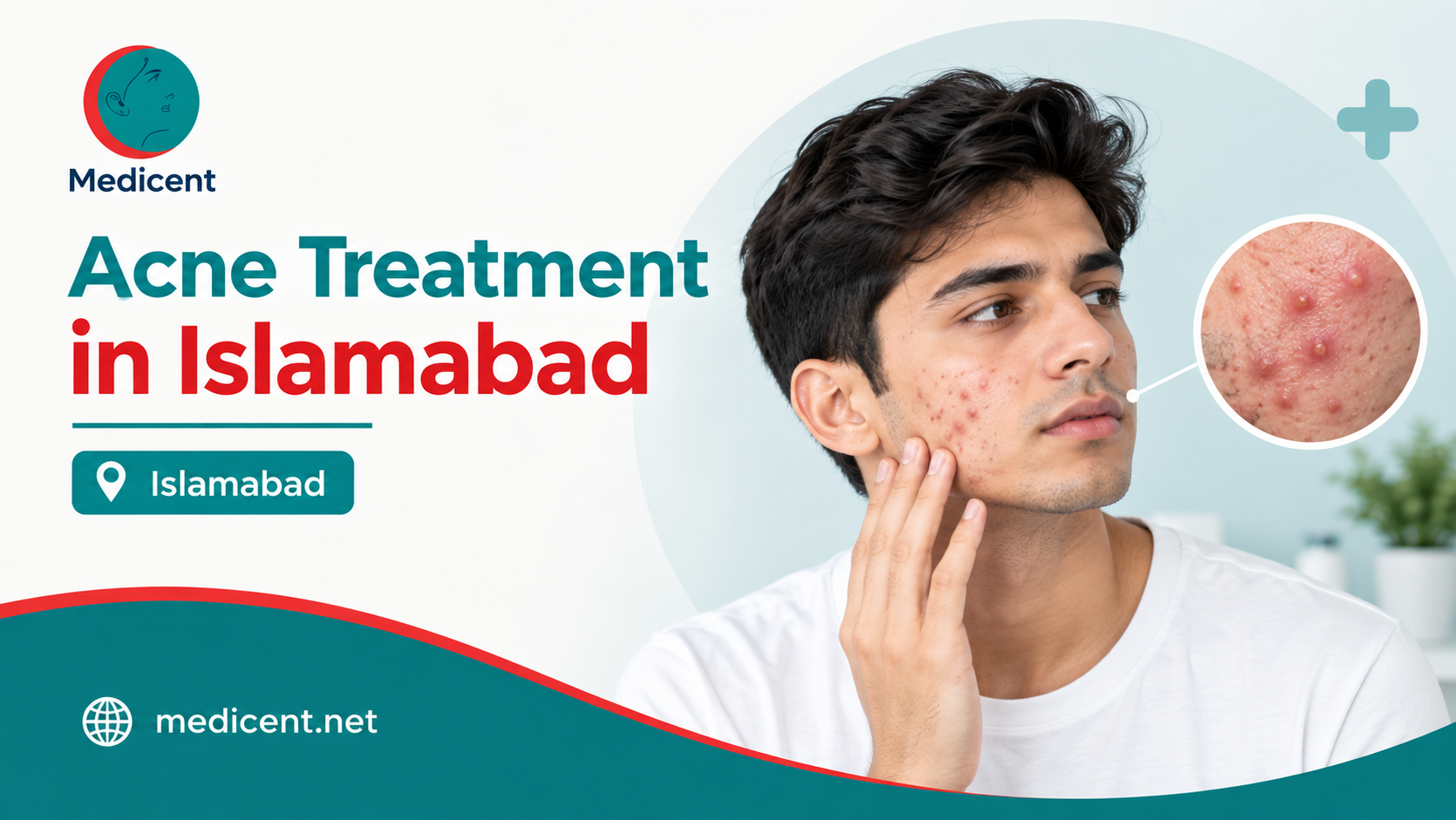 Read more about the article Islamabad: A True Guide To Acne Scar Treatment, Bid Goodbye To Old Acne Scars
